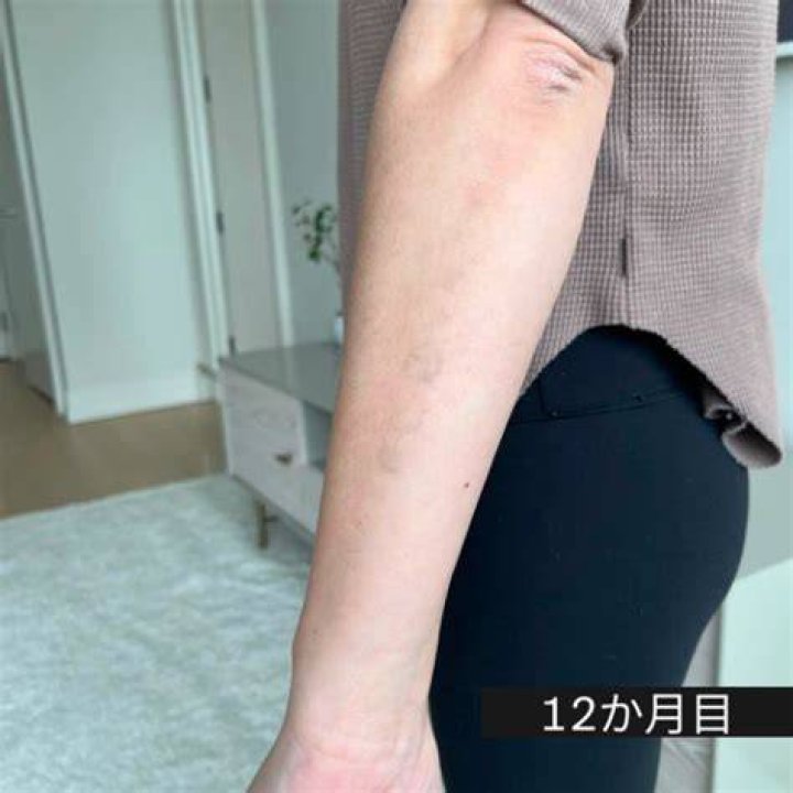 「2週間で消えるタトゥー」—期待とリスク、真相はどこにある？